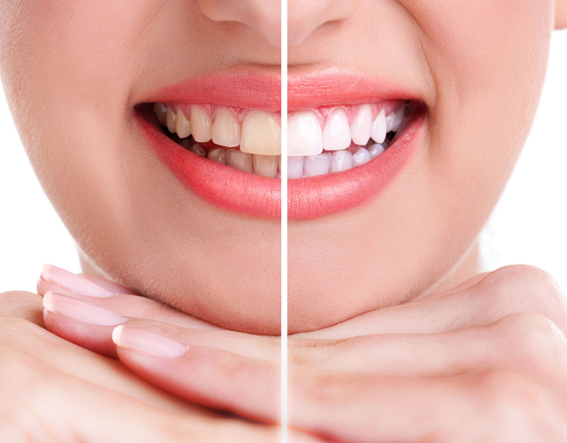 Teeth Whitening Marrickville